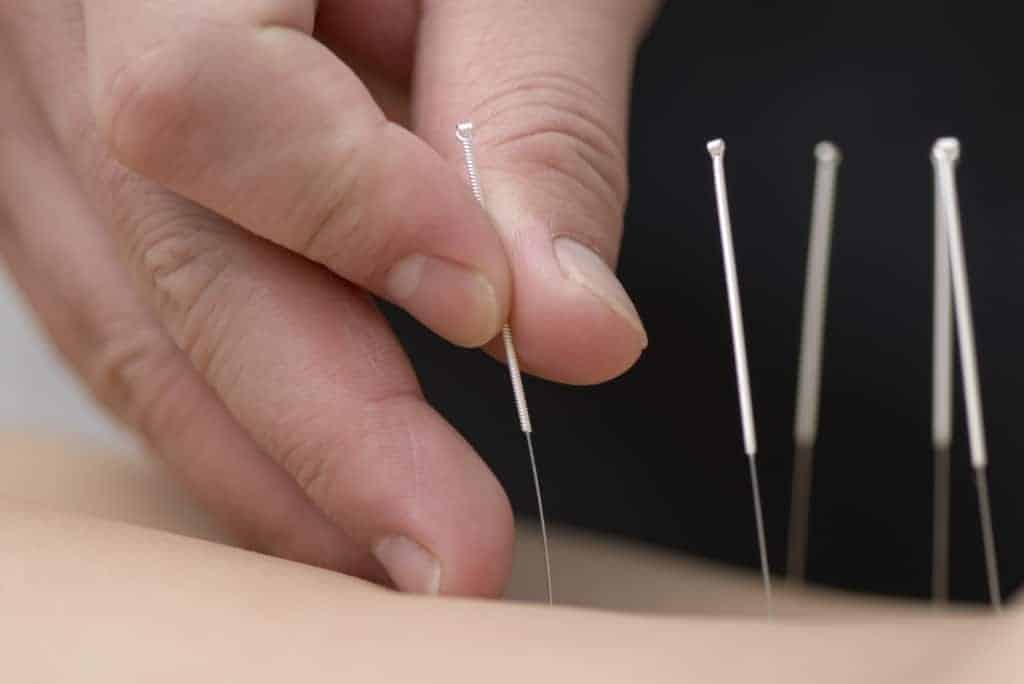 Acupuncture for MSK pains