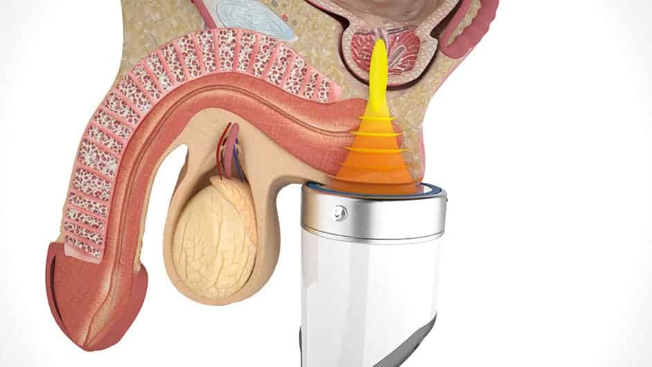 Shockwave for Erectile Dysfunction & CPPS
